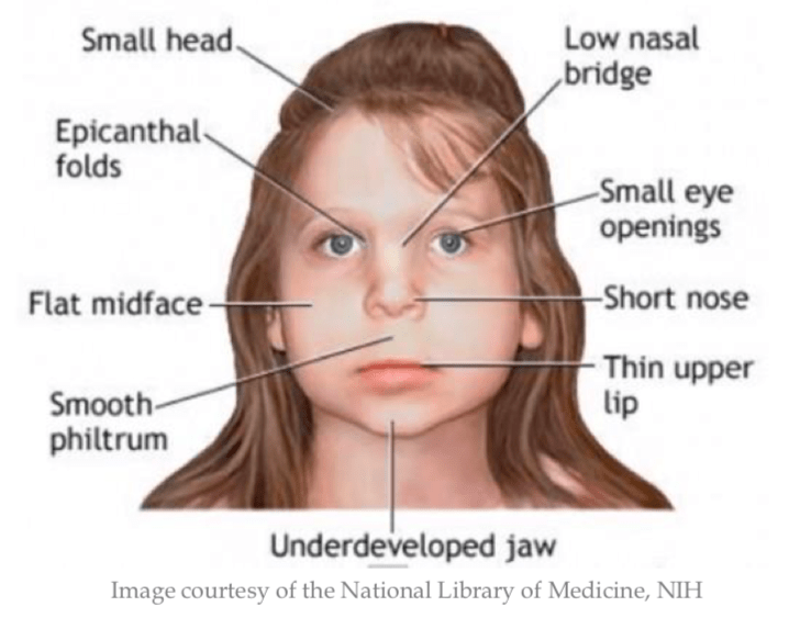 Another diagram showing a toddler with a small head, epicanthal folds, flat midface, smooth philtrum, underdeveloped jaw, low nasal bridge, small eye openings, short nose, thin upper lip, image courtesy of the National Library of Medicine, NH. 