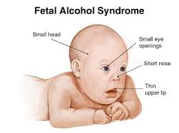 Of syndrome alcohol symptoms fetal Fetal Alcohol