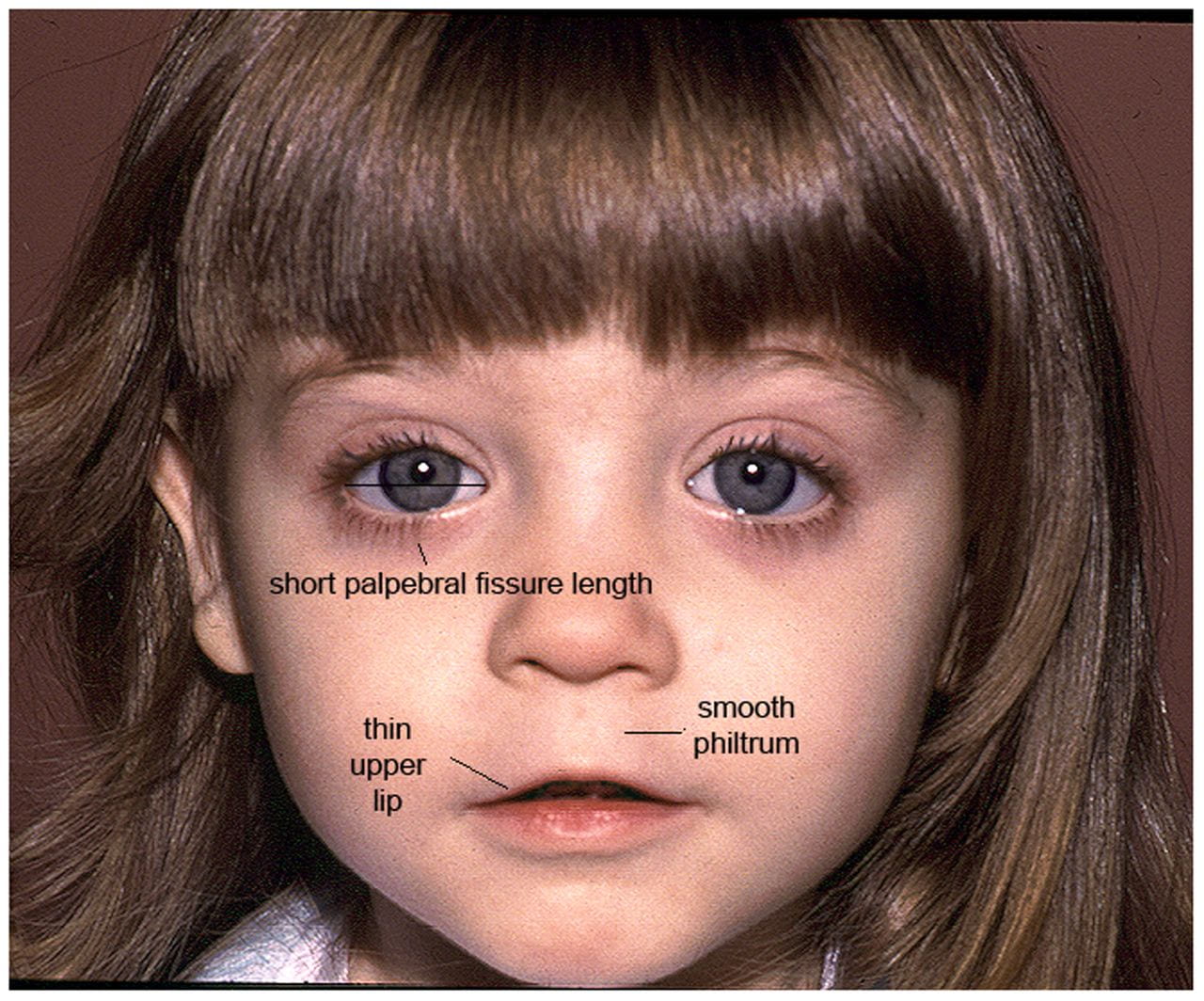 A photo describing a child with FAS - short palpebral fissure length, thin upper lip, smooth philtrum.