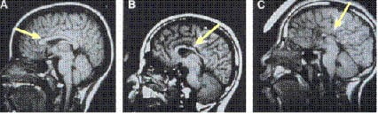 A scan of someone's brain. There is text saying "MRI showing agenesis of corpus callosum."